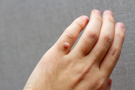 What is that Bump on My Skin? Filiform Wart, How To Treat Blackheads, Granuloma Annulare, Flat Warts, Types Of Warts, Warts Remedy, Skin Growths, Cold Home Remedies, Excessive Sweating