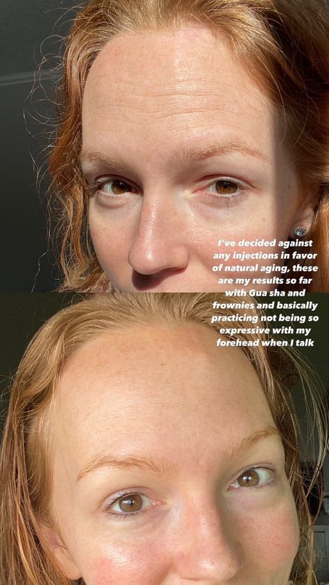 two pictures of the same woman's face, top picture shows horizontal lines on her forehead, bottom picture shows a smooth forehead, caption "I've decided against any injections in favor of natural aging. these are my results so far with gua sha and frownies and basically practicing not being so expressive with my forehead when i talk" Botox Alternative Products, Botox Cream, Frownies Facial Patches, Natural Botox, Botox Alternative, Forehead Wrinkles, Face Patches, Natural Aging, Face Wrinkles