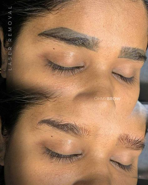 Laser Eyebrow Tattoo Removal Before and After Cases Remove Eyebrow Tattoo, Remove Tattoo, Tattoo Removal Before And After, Eyebrow Tattoo Removal, Red Eyebrows, Laser Removal, Eyebrow Trends, Laser Eye, Eyebrow Hacks