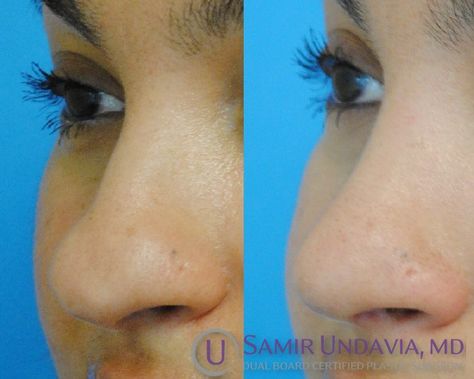 This 3 month before and after rhinoplasty shows a lifted nasal tip with subtle reduction in size and a more feminine side profile. Feminine Side Profile, Nose Surgery, More Feminine, Side Profile, Surgery, Make Up, Human