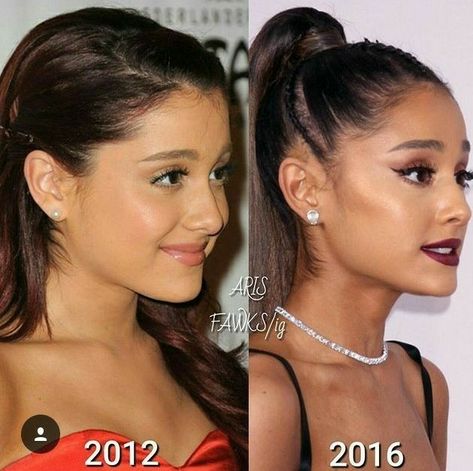 Ariana Grande  Before and After Surgery Ariana Grande Jawline, Ariana Grande Nose, Jaw Surgery, Medical Hospital, Dentist Doctor, Perfect Nose, Facial Contouring, Nose Surgery, Facial Plastic Surgery