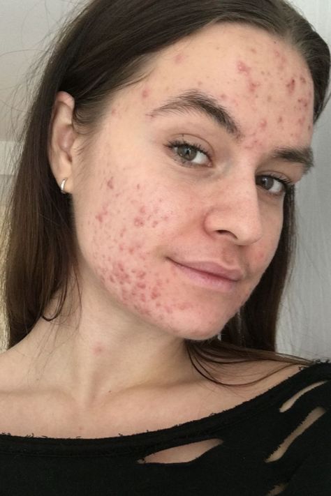 Accutane Before and After: 9 Women on Their Isotretinoin Side Effects Girls With Acne, Acne Positive, Acne Girl, Accutane Before And After, Beautiful Acne, Girl With Acne, Acne Positivity, Skin Positivity, People With Acne