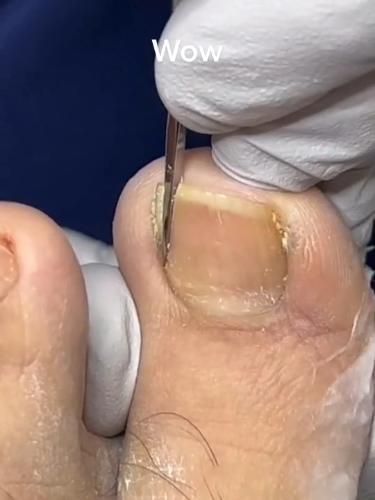 healthy toe nails home remedies Nails Remedies, Diy Nail Care, Toenail Removal, Nail Remedies, Skincare For Dry Skin, Nail Care Diy, Ingrown Nail, Weak Nails, Blackheads Removal