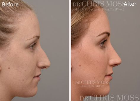 Nose Job Results | Rhinoplasty Before and After Natural Nose Job, Before After Rhinoplasty, Natural Nose, Nose Plastic Surgery, Nose Surgery Rhinoplasty, Rhinoplasty Nose Jobs, Rhinoplasty Before And After, Facial Fillers, Perfect Nose