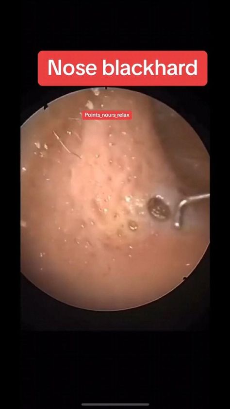 Pimple Poppìng, Ear Wax Removal Video, Satisfying Zit Popping Videos, Nose Pimples, Seasonal Skincare, Zit Popping Videos, Pimples Under The Skin, Zits Popping, Pimples On Face