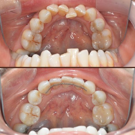 Before and after Invisalign and teeth whitening Invisalign Before And After, Before And After Invisalign, Teeth Whitening, Quick Saves