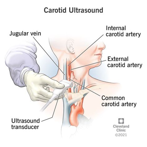 Carotid Ultrasound: Purpose, Procedure and Results Carotid Ultrasound, Carotid Artery Ultrasound, Vascular Sonography, Cardiac Sonography, Vascular Ultrasound, Sonography Student, Bypass Surgery, Medical Ultrasound, Carotid Artery