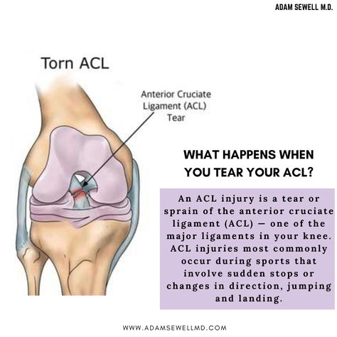 Knee Pain Stretches, Acl Injury, Acl Recovery, Knee Pain Remedy, My Knee Hurts, Swollen Knee, Anterior Cruciate Ligament, Knee Pain Exercises, Acl Tear