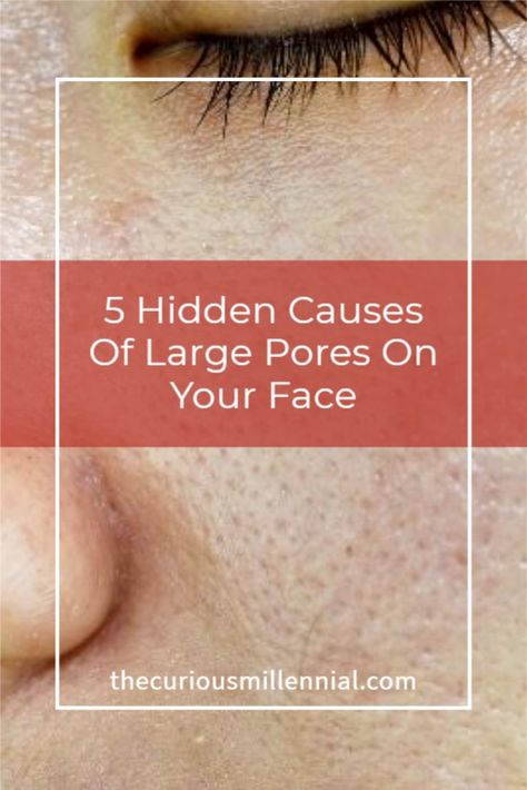 Big Pores On Face, Large Pores On Nose, How To Close Pores, Make Pores Smaller, Huge Pores, Open Pores On Face, Pores On Face, Best Pore Minimizer, Get Rid Of Pores