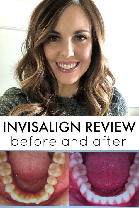 Invisalign Review on SixSistersStuff.com - the before and after, plus everything you need to know #invisalign #orthodontist #adultbraces @DefayOrthodontics Invisaline Before And After, Clear Aligners Before And After, Braces Vs Invisalign, Byte Aligners Before And After, Invisalign Tips And Tricks, Mewing Before And After, Invisalign Before And After, Invisalign Aesthetic, Before And After Invisalign