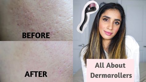 What is Derma Rollers? + How to do MicroNeedling at Home? Before and After Results #beauty #dermarollers #howto #beforeandafter #microneedling #skincare #derma Microneedling Before And After At Home, Dermaroller Before And After, Microneedling At Home, Derma Rolling, Healing Waters, Derma Roller, Fall Wear, Winter Trends, Seasonal Fashion