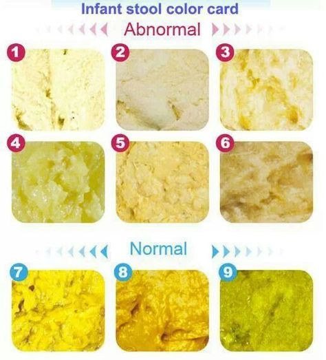 Breastfeeding babies stool Baby Poop Guide, Biliary Atresia, Future Soulmate, Baby Poop, Breastfeeding Foods, Newborn Mom, Feeding Baby, Baby Life Hacks, Baby Education