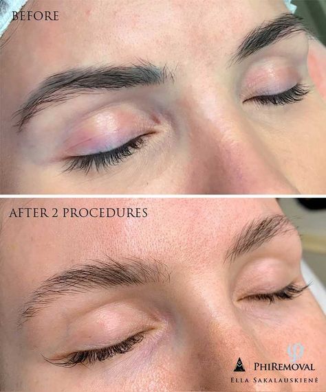 Read our guide for detailed information about 3 most popular methods of microblading removal – how they’re done, if they work, and how much they cost. #microbladingremoval #removingmicroblading #pmuremoval #permanentmakeupremoval #removingpermanentmakeup #removingeyebrowtattoo #eyebrowtattooremoval #pmuhub Laser Tattoo Removal Eyebrows, Remove Microbladed Brows, Permanent Makeup Removal, Eyebrow Tattoo Removal, Brows Microblading, Eyebrow Embroidery, Laser Removal, Brow Tattoo, Permanent Makeup Eyebrows