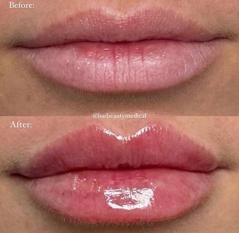 One of our favourite lip transformations done by our talented injector, Nurse Noor! This client wanted to enhance her natural lips without overfilling. Noor focused on balancing both the upper and bottom lip and the results are amazing💋💋 1ml of filler used! Send us a dm or give us a call to book your lip filler appointment with Nurse Noor 💉 ✨Barbeauty.ca ✨Info@barbeauty.ca ✨(416) 923 1200 ✨46 Fort York Blvd #lipfiller #filler #torontolipfiller #torontofiller #fillertoronto #injectables ... Bad Lip Filler, Injector Nurse, Lip Filler, Bottom Lip, Lip Fillers, Natural Lips, Fort, Lips, Quick Saves