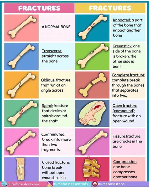 Basic Medical Knowledge, Sports Medicine Physician, Emt Notes, Open Fracture, Nursing School Studying Cheat Sheets, Types Of Fractures, Emt Study, Medical Terminology Study, Medical Assistant Student