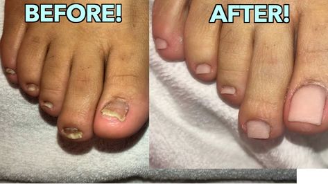 Nail Infection Builder Gel Toenails, Overlay Toenails, Acrylic Toe Nails Before And After, Fake Toe Nails Acrylics, Pedicure Acrylic Toenails, Acrylic Overlay On Toes, Toe Extensions, Overlay On Toes, Toe Nail Acrylic