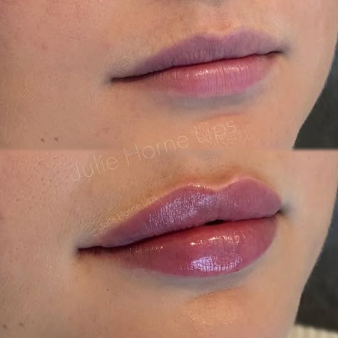 JULIE HORNE ACADEMY on Instagram: “Natural result with 1 ml Restylane Defyne. Improved proportions, crisp border and natural pout 💉💋 Swipe for live video ➡️ . . . . Medical…” Filler Transformation, Lip Permanent Makeup, Lips Inspiration, Botox Lips, Facial Fillers, Lip Augmentation, Facial Aesthetics, Cosmetic Dermatology, Lip Filler