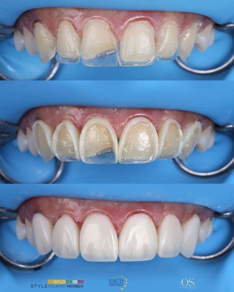 Dr.Osama Shaalan | Free hand palatal shell , unica frame before and after layering the veneering layer . Polished by lucida WDB composite ,SI2 + E +MP… | Instagram Teeth Makeover, Dental Images, Composite Veneers, Dental Aesthetics, Dental Videos, Dental Photography, Dental Fun, Aesthetic Dentistry, Perfect Teeth