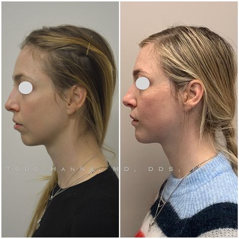 Dr. Todd Hanna, MD, DDS, FACS on Instagram: “Revisiting this chin augmentation case because I want to drive home the value of using lines and angles in facial esthetics. Steiners and…” Facial Esthetics, Chin Augmentation, Lines And Angles, I Want, Facial, Drive, On Instagram, Instagram