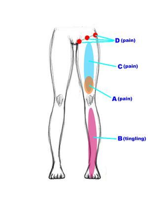 Pain locations: Left Front Thigh Pain can be a diagnostic saga.   Dear webmaster. It is Tim, male, 41 years old from Hong Kong. I've read several of your articles before Thigh Cramps, Leg Muscle Pain, Hip Pain Relief, Pain Relief Remedies, Back Pain Remedies, Upper Back Pain, Leg Cramps, Thigh Muscles, Sciatic Nerve Pain