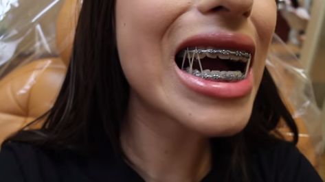 Metal Braces Aesthetic, Braces With Power Chains, Braces Power Chain Aesthetic, Light Blue Power Chain Braces, Braces Rubber Bands, Braces Elastics, Adult Braces, Orthodontic Appliances, Braces Girls