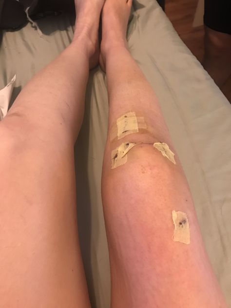 Leg Surgery Snapchat, Bandaged Knee Aesthetic, Leg Accident Real Pic For Women, Knee Wound Fake Story, Leg Wound Fake Story, Skinned Knees Aesthetic, Injury Aethstetic, Scraped Knees Aesthetic, Knee Aesthetic