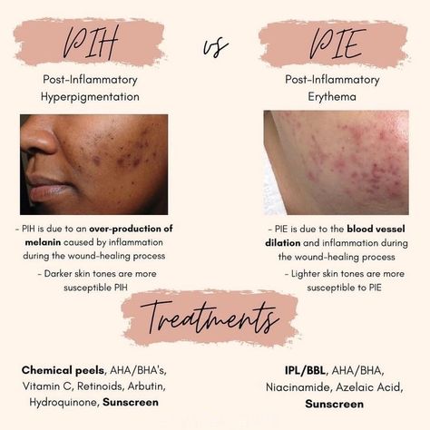 Esthetician School, Beauty Skin Quotes, Post Inflammatory Hyperpigmentation, Skin Facts, Skin Care Business, Skin Advice, Skin Aesthetics, Acne Dark Spots, Random Aesthetic