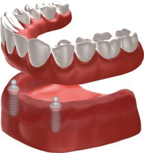 Snap On Dentures, Teeth Makeover, Permanent Dentures, Prosthetic Teeth, Affordable Dentures, Prosthetic Device, Picture Perfect Smile, Denture Implants, Dental Tips