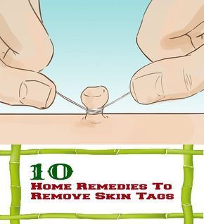 Home Remedies To Remove Skin Tags. For large tags put baby theething  jell on the tag to numb it. Skin Tags Essential Oils, Remove Skin Tags, Remove Skin Tags Naturally, Tea Tree Oil For Acne, Home Remedies For Skin, Skin Tags, Skin Disorders, Natural Therapy, Skin Remedies