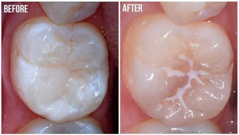 Dental Sealants, Sensitive Teeth Remedy, Teeth Implants, Dental Bridge, Nice Teeth, Botox Injections, Dental Crowns, Pediatric Dentistry, Family Dentistry