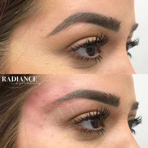 Fox Eye Surgery, Beauty Technician, Brow Lift Surgery, Jaw Reduction Surgery, Cosmetic Nurse, Aesthetic Procedures, Face Surgery, Plastic Surgery Gone Wrong, Brow Threading