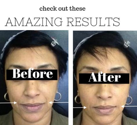 Smile Line Fillers Before And After, Smile Lines Filler Before And After, Invisible Aesthetic, Filler Injection Techniques, Hair Filler Dr Cyj, Facial Symmetry Filler, Mid Face Filler, Filler Injection Sites, Plastic Surgery Photos