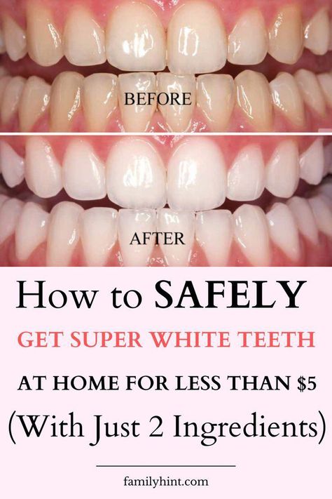 Illuminate your smile with these six speedy methods to whiten your teeth at home: 1. Baking Soda & Hydrogen Peroxide 2. Activated Charcoal Whiten Teeth Naturally, Whiten Your Teeth At Home, Alcohol Free Mouthwash, Tooth Decay Remedies, Get Whiter Teeth, Tooth Whitening, Teeth Whitening Remedies, Teeth Whitening Diy, Whitening Products