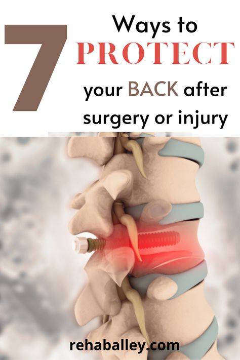 This picture displays a human spine with a screw going through it. This can be used as an example of a back surgery. Post Spinal Fusion Workout, Lumbar Surgery Recovery, Lumbar Laminectomy Recovery, Herniated Disk Surgery Recovery, Lower Back Injury Workout, Lower Back Injury Recovery, Back Injury Recovery, Back Injury Exercises Recovery, Back Strengthening Exercises After Surgery