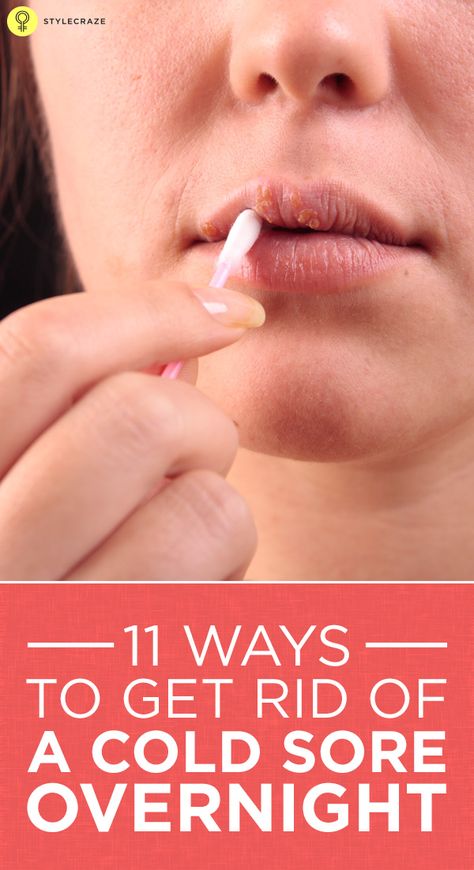 11 Ways To Get Rid Of A Cold Sore Overnight Get Rid Of Cold, Fever Blister, Cold Sores, Canker Sore, Cold Sores Remedies, Diy Remedies, Cold Sore, Cold Remedies, Lose 40 Pounds