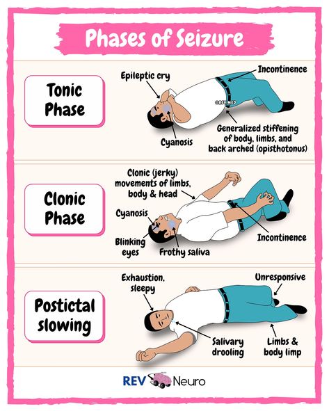 What city are you from? 🇺🇸 Let us know in the comments! Topic: Seizure & Epilepsy. My neurologist says I ‘Carpe diem’ too much… notes ⤵️ 🧠 Neuro is tough… that’s why we have a dedicated page for your needs this year 👉🏼 @rev.neuro 🟣 Subscribe now to unlock lessons and content in our member’s area on Instagram ➡️ @rev.med Seizure & Epilepsy ✅ Pathology & Causes Seizure: An acute, transient (<5 min) neurological event caused by abnormal paroxysmal electrical discharges within the brain ca... Nclex Notes, Seizures Non Epileptic, Brain Anatomy And Function, Types Of Seizures, Seizures Awareness, Nursing Essentials, Neurological System, Nursing School Essential, Nurse Study Notes