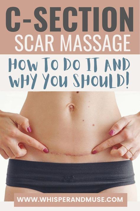 #NaturalHealthRemediesBook Scar Tissue Massage, Scar Massage, C Section Scar, C Section Workout, C Section Scars, C Section Recovery, Post Pregnancy Workout, Losing 40 Pounds, Baby Workout