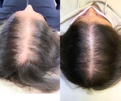 Hair Regrowth Before And After, Hair Prp Before And After, Prp For Hair, Hair Ext, Prp Hair, Hair Facts, Hair Repair Treatments, Hair Therapy, Skin Clinic