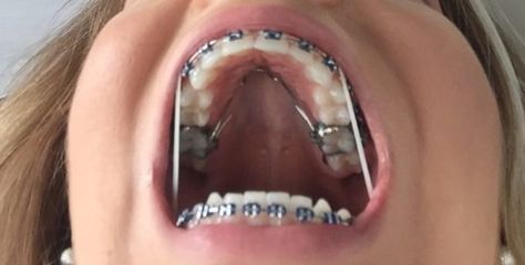 Braces Expander, Headgear Braces, Perfect Teeth Braces, Before After Body, Braces Before And After, Braces Rubber Bands, After Braces, Braces Bands, Braces Elastics