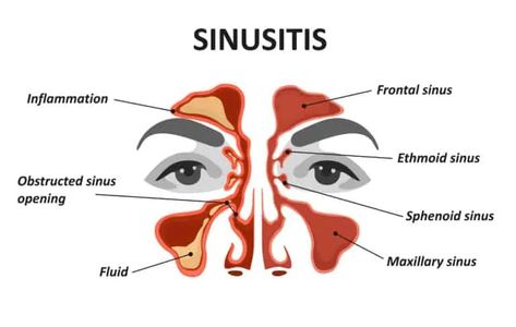 Clogged Sinuses, Sinus Inflammation, Remedy For Sinus Congestion, Sinus Remedies, Home Remedies For Sinus, Maxillary Sinus, Sinus Congestion Relief, Chronic Sinusitis, Sinus Pain