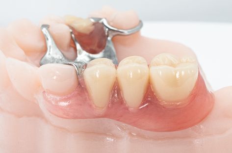 At ROE Dental Lab, we're experts in partial dentures, having crafted over 50,000 partials in just the last five years. We understand that every smile is unique, which is why we offer a wide range of partial denture options to suit various needs and preferences! #roedentallab #removables #partialdenture #removabledenture Snap On Smile, Dental Business, The Last Five Years, Partial Dentures, Last Five Years, Dental Laboratory, Dental Procedures, Dental Lab, Online University