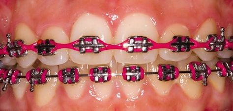 burgundy braces bands. Power chain on top Get the latest in orthodontic treatments at http://OrthoMontreal.com Power Chain Braces, Invisible Teeth Braces, Braces Colors Combinations, Pink Braces, Red Braces, After Braces, Braces Bands, Braces Cost, Cute Braces Colors