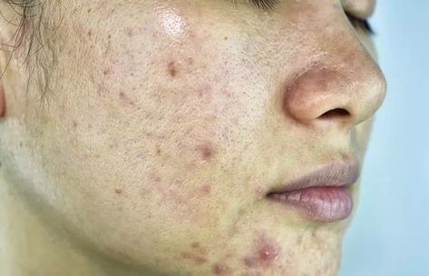 Period Acne, Different Types Of Acne, Moderate Acne, Acne Vulgaris, Severe Acne, Types Of Acne, How To Get Rid Of Pimples, Acne Breakout, How To Get Rid Of Acne