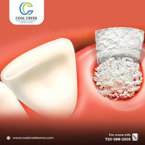 When getting an implant, there must be a sufficient amount of bones in the affected area. In such cases, bone grafting is done to help regrow any deteriorated bone. For more details contact us. 🌐 www.coalcreekoms.com ☎ +1720-588-2505 #CoalCreekOMS #OralSurgeon #OralSurgery #DentalImplant # Bone Grafting, Oral Surgeon, Dental Implants, Contact Us, Bones