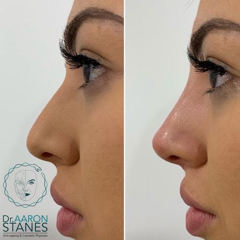 Nonsurgical Nose Job, Nose Surgery Rhinoplasty, Nose Fillers, Rhinoplasty Nose Jobs, Nose Reshaping, Pretty Nose, Beauty Procedures, Facial Fillers, Perfect Nose