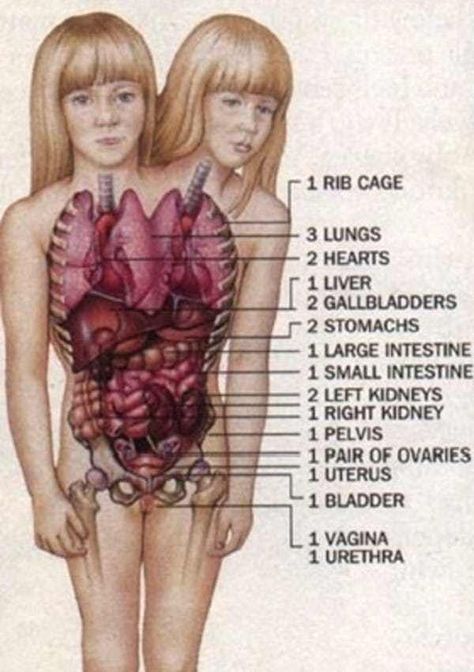 Their Internal Organs Are A Un... is listed (or ranked) 2 on the list 15 Things Most People Don't Know About Conjoined Twins Abby And Brittany Human Oddities, Conjoined Twins, Internal Organs, Medical Anatomy, Large Intestine, Body Anatomy, Gambar Figur, Summer Wedding Outfit Guest, The Human Body