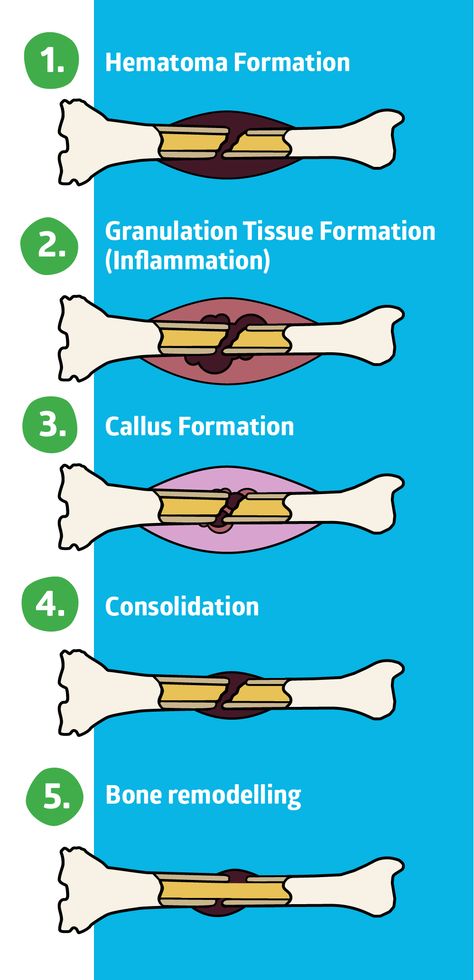 Bone Healing Process, Metatarsal Fracture, Musculoskeletal Disorders, Heal Broken Bones, Nursing Inspiration, Fracture Healing, Forensic Anthropologist, Bone Healing, Nursing Cheat