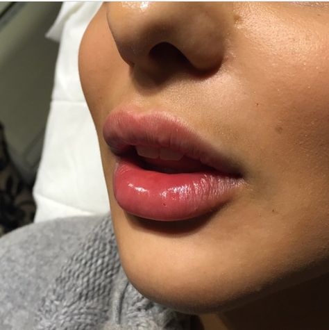 Perfect lip fillers                                                                                                                                                                                 More Nice Lips Natural, Full Lips Injections, Madelyn Cline Lip Fillers, Heavy Lower Lip Filler, Lip Fillers Before And After 1ml, Lip Filler Shape Ideas, Natural Lip Fillers, Lip Filler Before And After, Lip Fillers Juvederm