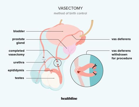 Vasectomy: Procedure, Benefits, and Risks Female Sterilization, Creative Book Cover Designs, Forms Of Birth Control, Birth Control Methods, Creative Book Covers, Biology Notes, Single Woman, Shadow Pictures, What Happened To You