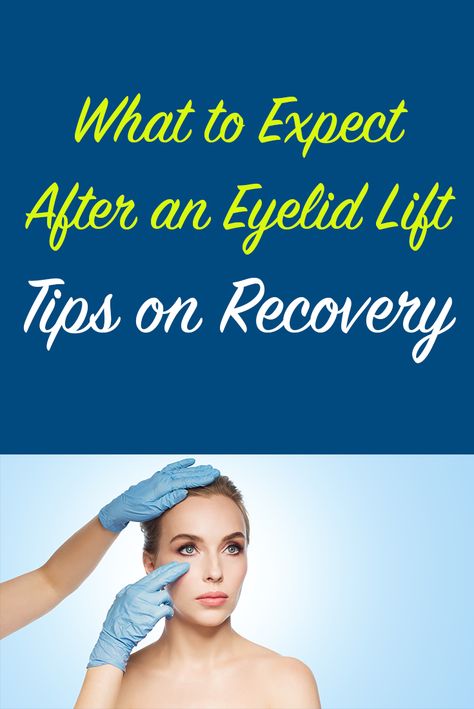 Upper Eyelid Lift Surgery, Eyelid Lift Surgery Before After, Eye Lid Surgery Before And After, Blephoraplasty Surgery, Hooded Eye Surgery, Eye Lid Surgery, Facelift Recovery, Eye Lift Surgery, Plastic Surgery Recovery